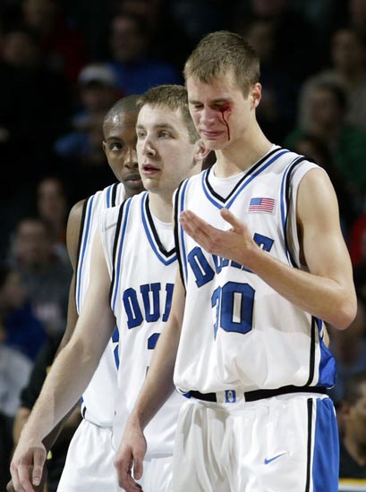 Jon Scheyer Bloody Eye